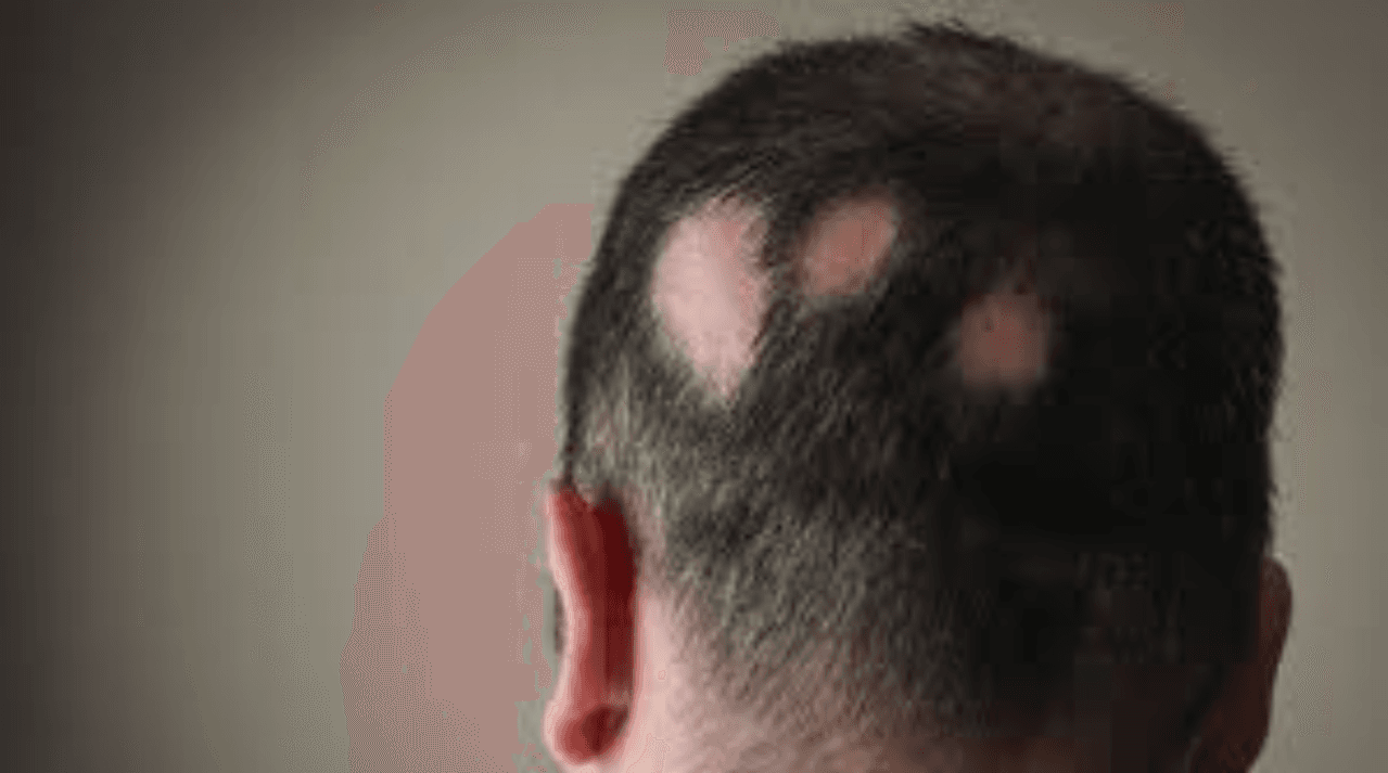 a man having Alopecia Areata on back of his head, visible big patches of Alopecia Areata