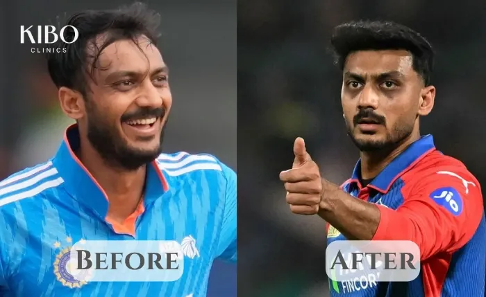 Before and after hair transplant images (visual progression) of cricketer Axar Patel
