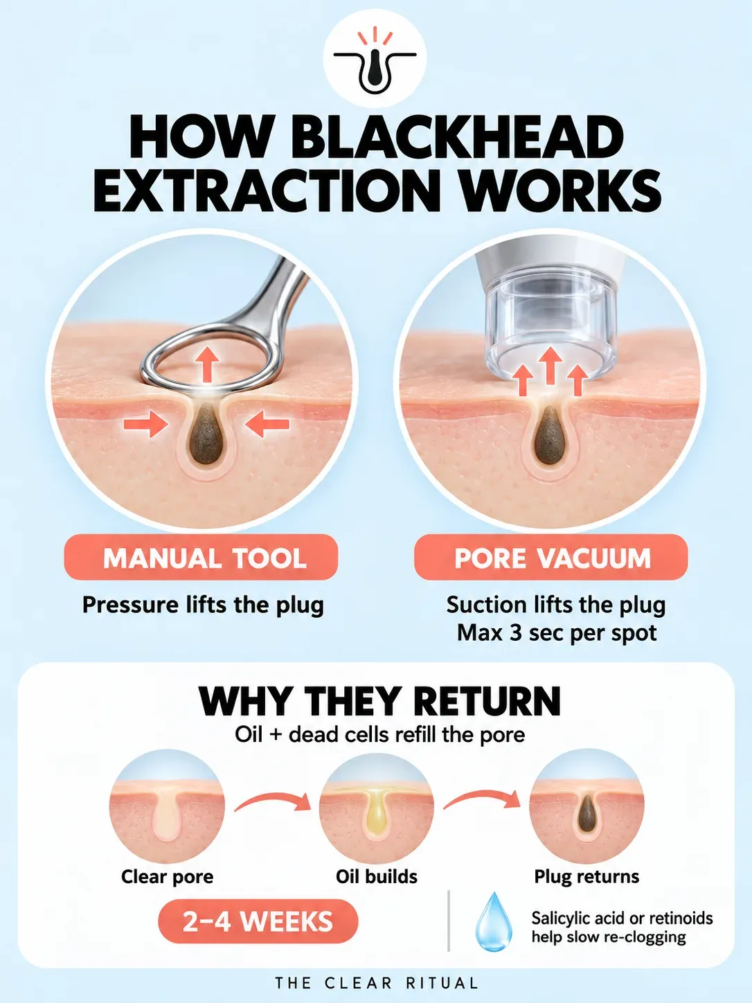 How blackhead extraction works: how a comedone extractor and pore vacuum remove blackheads
