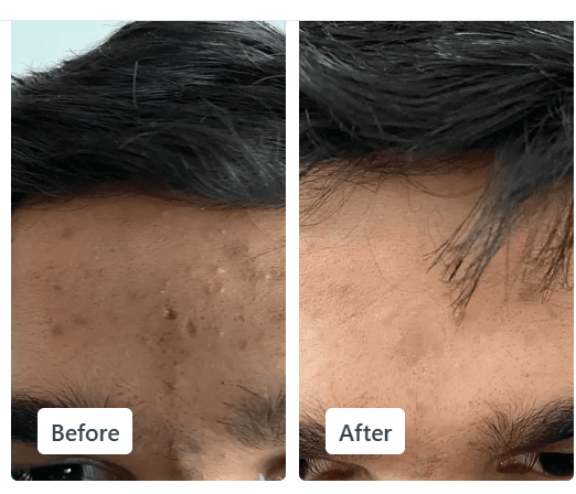 Clear Ritual acne before and after result 2