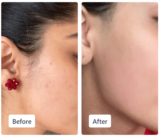 Clear Ritual acne before and after result 1