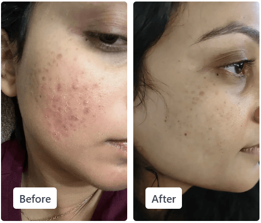 Clear Ritual acne before and after result 3