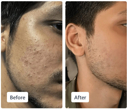 Clear Ritual acne before and after result 4