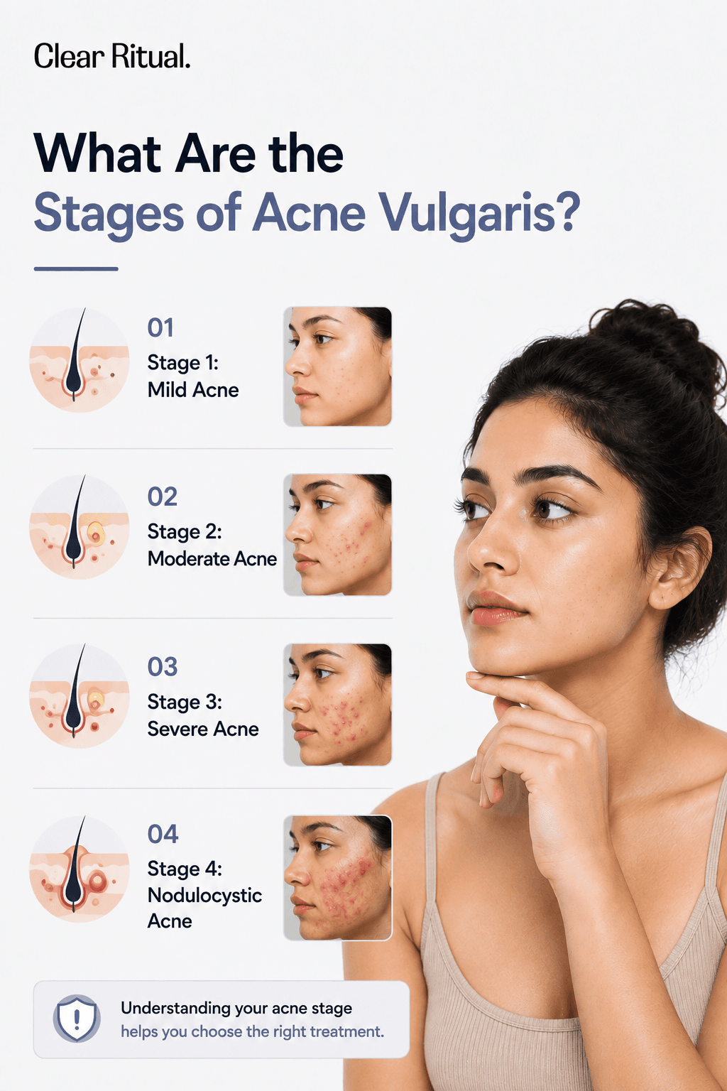 Stages of Acne Vulgaris.png