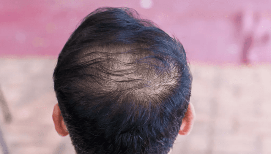 back photo of head of a man showing Telogen Effluvium