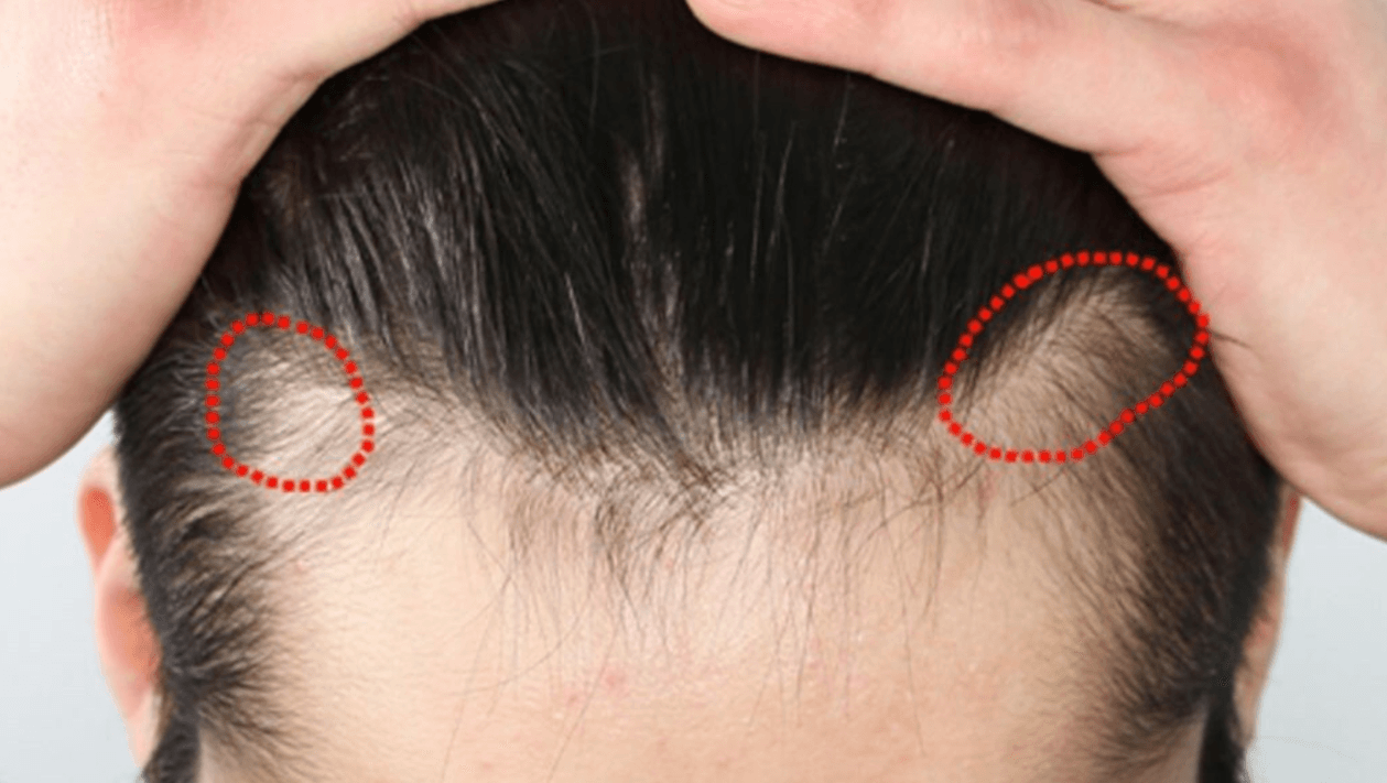 man holding his front hair back to show Traction Alopecia on two sides of his hairline
